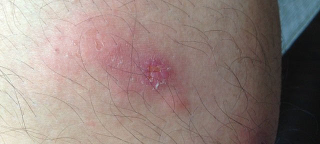 ブヨ、死ぬほどかゆい。気が狂いそう。誰か、ブヨをやっつける益虫をDNA操作で作って欲しい。